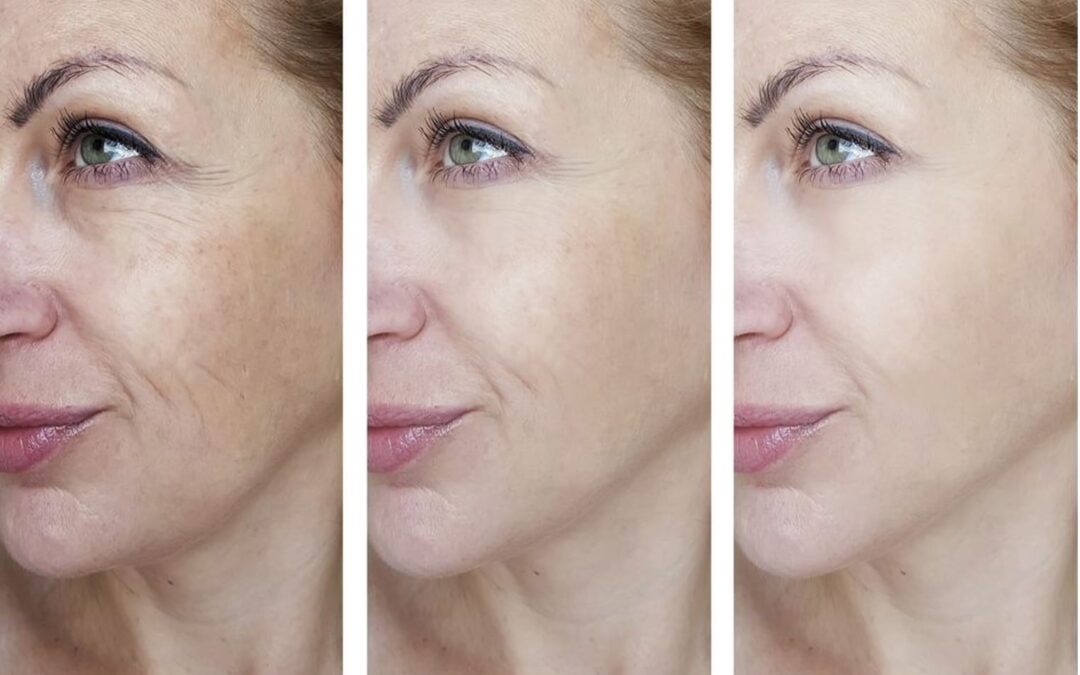 [LARENS] Jak szybko przywrócić skórze elastyczność